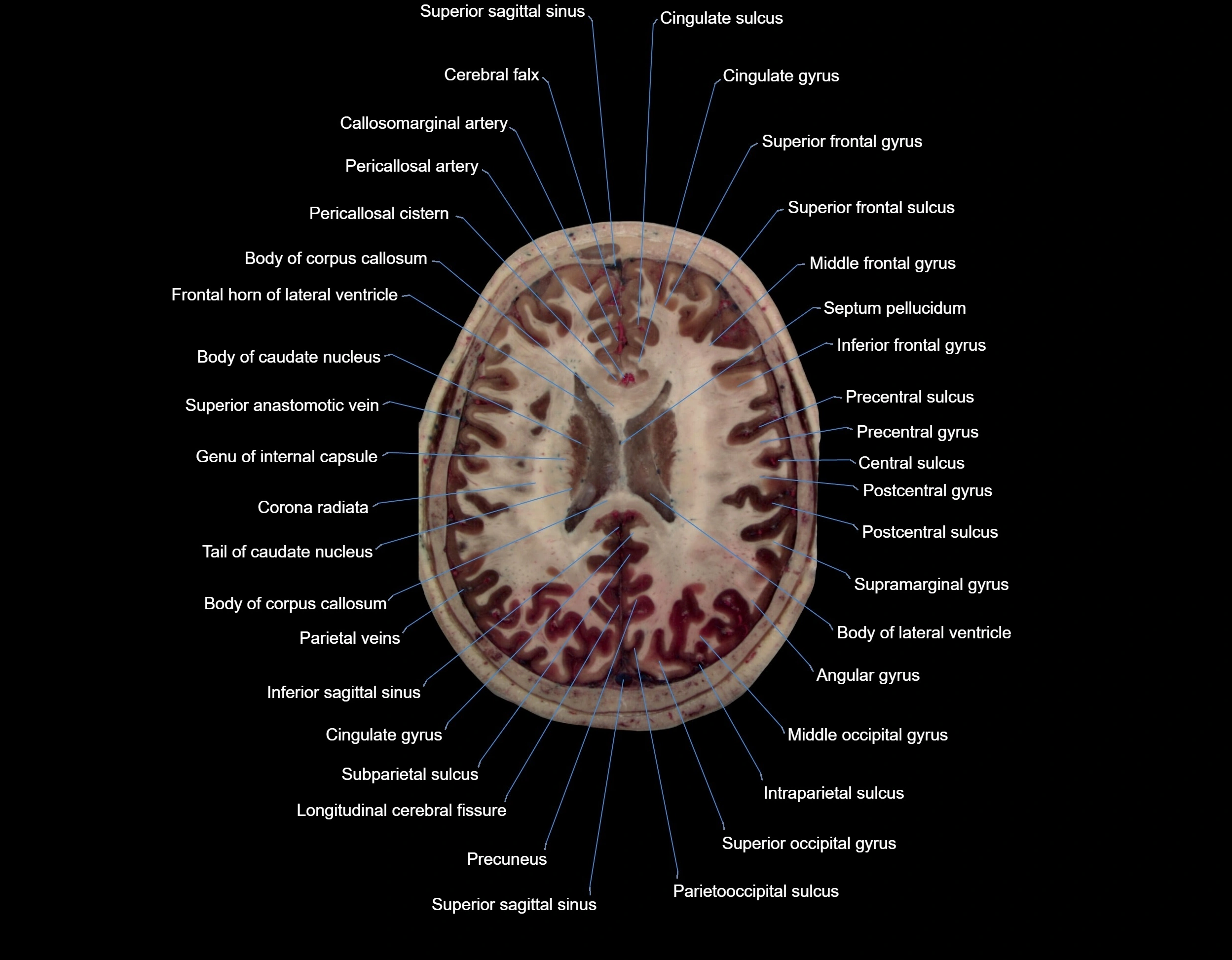 MRI Brain axial cross sectional radiology anatomy 3T image  -img-000051.webp